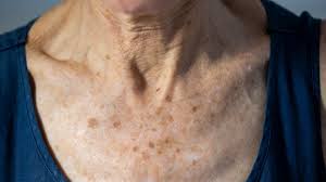 Image result for liver spots on legs