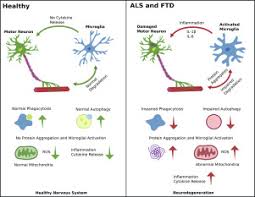 Implications Of Microglia In Amyotrophic Lateral Sclerosis And Frontotemporal Dementia Sciencedirect