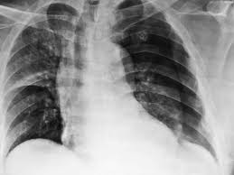 Image result for Pneumothorax