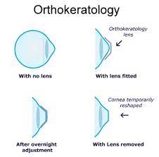 Ortho K Or Orthokerathology Is It Safe Evershine Optical