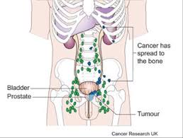 Here are 10 more facts about prostate cancer. The Stages Of Prostate Cancer Marie Keating Foundation