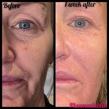 Check this beautiful lady out! 11 days after plasma pen! I did her frown  lines, whole eyes and whole mouth. It's taken years off my client 😊😊 10  weeks of Tightening and