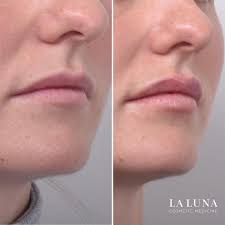 Contains natural ingredients including seaweed and vitamin e the jawline mask may look a little odd, but users swear it works. Jowl Lift Sydney Tighen Sagging Skin Lunchtime Threadlift Treatment