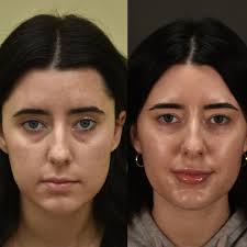 Before and after lower blepharoplasty with fat repositioning along with fat  transfer to midface and under eyes. Her expression has a softer, more  inviting appeal after surgery. A lovely result for this