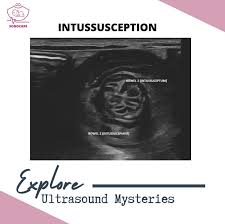 Image result for Intussusception