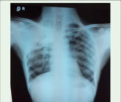 It's not just your upper chest. Chest Radiography Showing Right Upper Zone Opacity And Fibrosis Download Scientific Diagram