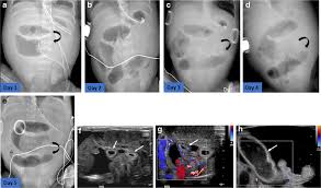 Image result for Necrotizing Enterocolitis