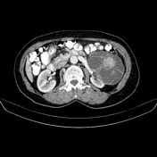 Bosniak Classification System Of Renal Cystic Masses