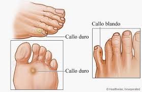 Esta es una forma bastante efectiva de deshacerse del hongo del dedo del pie. Y Si Tenemos Clavos En Los Pies Stillness Espai De Salut