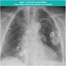 Fear not, for business card scanner apps are here to help. Perforation Ventriculaire Droite Tardive Par Sonde De Pacemaker Journal De Cardiologie