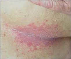 Image result for heat rash under breasts