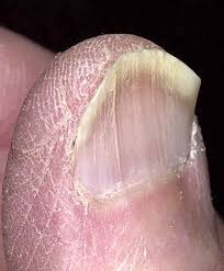 Image result for Koilonychia feet