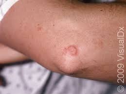 Image result for Eczema nummulare