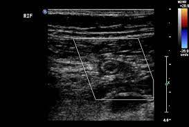 Normal Vermiform Appendix Radiology Case Radiopaedia Org