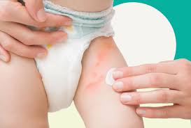 Image result for sweat rash on back baby