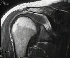 Image result for Shoulder MRI