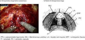 Image result for Radical Prostatectomy