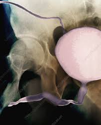 Image result for Voiding Cystourethrogram