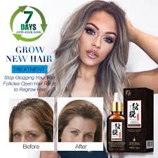 The products are made from special blends of botanical extracts, nutrients and aromatic oils, which are unique and highly effective product formulae. Hair Growth Essence Oil Hair Growth Serum Anti Hair Loss Treatment Solution Hair Care Hair Loss Produrts Hair Tonic Hair Loss Products Aliexpress