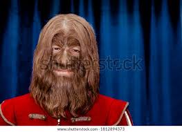 Image result for Hypertrichosis