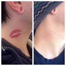 Popular device remove tattoo of good quality and at affordable prices you can buy on aliexpress. What You Need To Know About Tattoo Removal Trending Lancasteronline Com