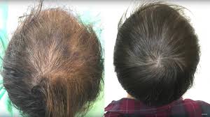 Low iron can lead to anemia, which can lead to increased hair shedding. Zach Kornfeld On Twitter A Quick Thread On Hair Loss And Some Things I Ve Learned Through The 2 Videos I Ve Made I M Not A Doctor Just A Dude Who Learned A Bunch