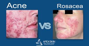 I went to the dermatologist for my lupus rashes i get on my face and she explained some of the problem was acne and rosacea. What Diseases Mimic Rosacea