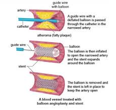 The catheter has a tiny balloon at its tip. Angioplasty Cost Price Coronary Angioplasty Ukraine Heart Institute Price