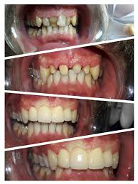 د بلال حكيم اوغلو Bilal Teeth Twitter