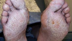 Treatment with these vitamins has reportedly helped in treating this. When Vitamin And Nutritional Deficiencies Cause Skin And Nail Changes Podiatry Today