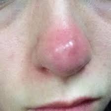 Was Sind Das Fur Monsterpickel Und Wie Krieg Ich Die Los Pickel Nase