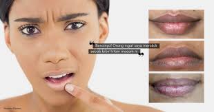Umumnya dalam kondisi perubahan fisiologis seperti saat sedang hamil, tidak ada terapi spesifik yang diberikan. Hapuskan Bibir Hitam Dapatkan Senyuman Pink Jambu Dengan 8 Cara Mudah Ini Nona