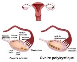 Ovaires polykystiques traitement naturel