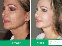 Face Neck Before After Photos Kass Center For Cosmetic And Plastic Surgery This is the layer of tissue. face neck before after photos