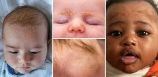Image result for yellow scabs on the face in children