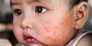 Check spelling or type a new query. Cara Tepat Mengatasi Biang Keringat Pada Wajah Bayi