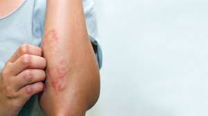 أشهر 10 أعراض سرطان الدم وطرق علاجه شفاء