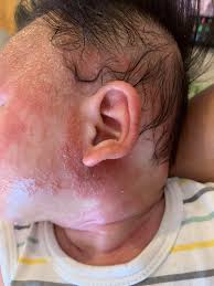 Image result for yellow scabs on the face in children