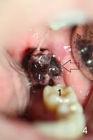 Jul 10, 2019 · after wisdom teeth removal, you can also expect some bleeding for the first few hours. Blood Clot Wisdom Tooth Extraction Novocom Top