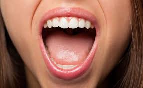 Image result for cancer of tongue