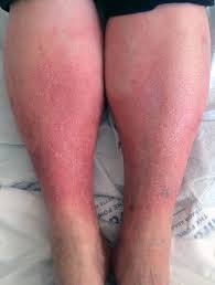 Image result for Lipodermatosclerosis