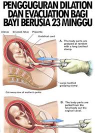 Cara menggugurkan kandungan dengan ragi tape. Pengguguran Janin