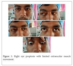 Image result for Proptosis