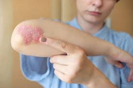 Image result for psoriasis