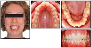 Pulse Accelerated Treatment Method