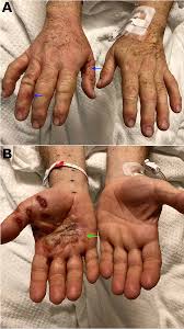 Image result for dyshidrosis
