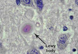 Lewy body dementias (lbds, or lewy body disorders) describe two similar common dementias that are characterized by changes in thinking, movement, behavior, and mood. Lewy Body Demens Nationalt Videnscenter For Demens