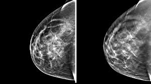 This includes mammography, ultrasound and breast mri. 3 D Mammography Finds More Tumors But Questions Remain Shots Health News Npr