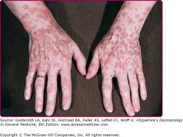 Image result for human papillomavirus symptoms