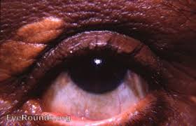 Image result for xanthelasma of eyelid